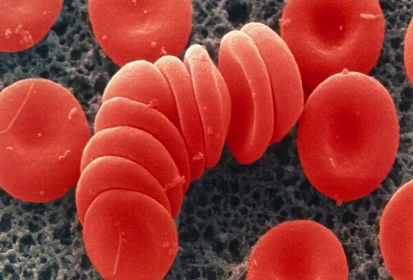 Coloured SEM of red blood cells, rouleau formation