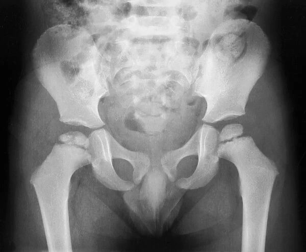 Growth disorder of thigh bone, X-ray