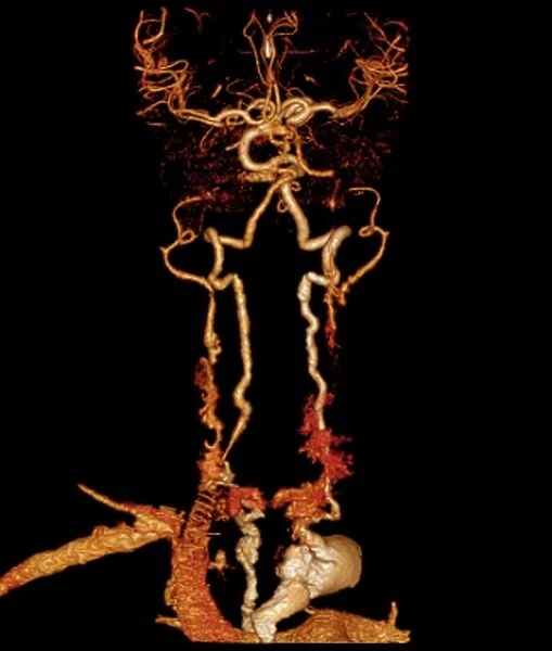 Takayasus arteritis, 3d CT scan