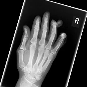 Amputated fingers, X-ray C017 / 7150