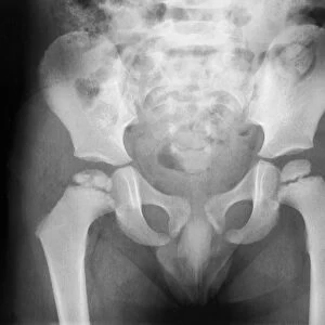 Growth disorder of thigh bone, X-ray