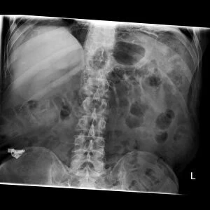 Swallowed key and blades, X-ray C017 / 7559