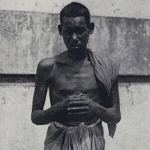 Man with a grotesquely swollen leg caused by lymphatic filariasis, Cochin, India (b / w photo)